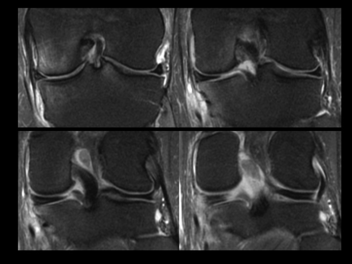 Figure 4 for case posterior root of medial meniscus ( RID2777 )
